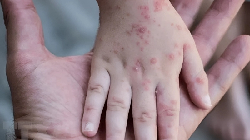 Yaba Monkey Tumor Virus Infection shares traits with tanapox virus