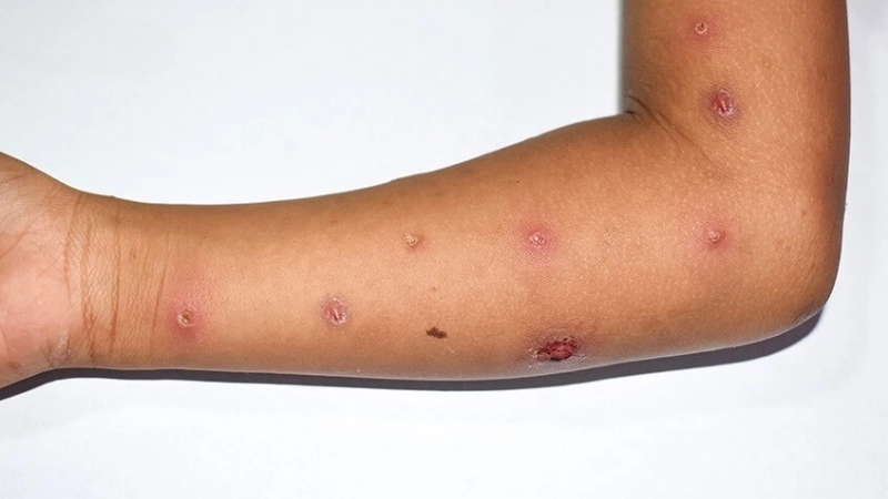 Yaba Monkey Tumor Virus Infection studied in virus classification