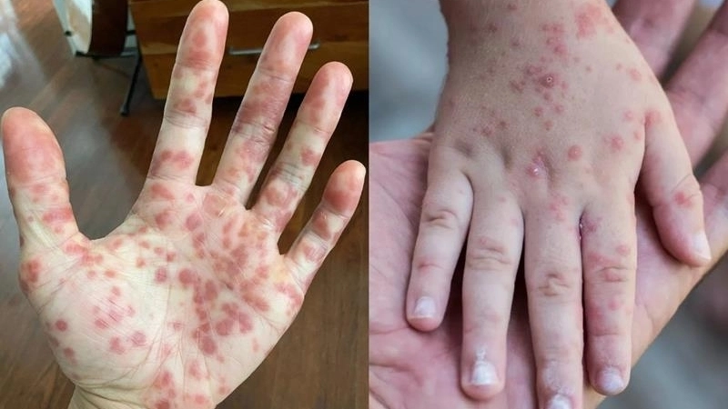 Yaba Monkey Tumor Virus Infection known as a zoonotic disease