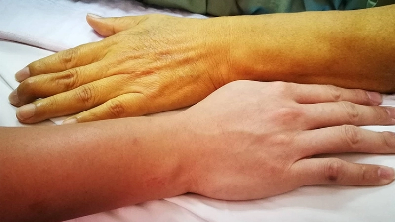 Find the right yellow fever treatment options