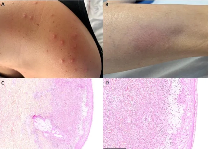 A patient describing common yersiniosis symptoms