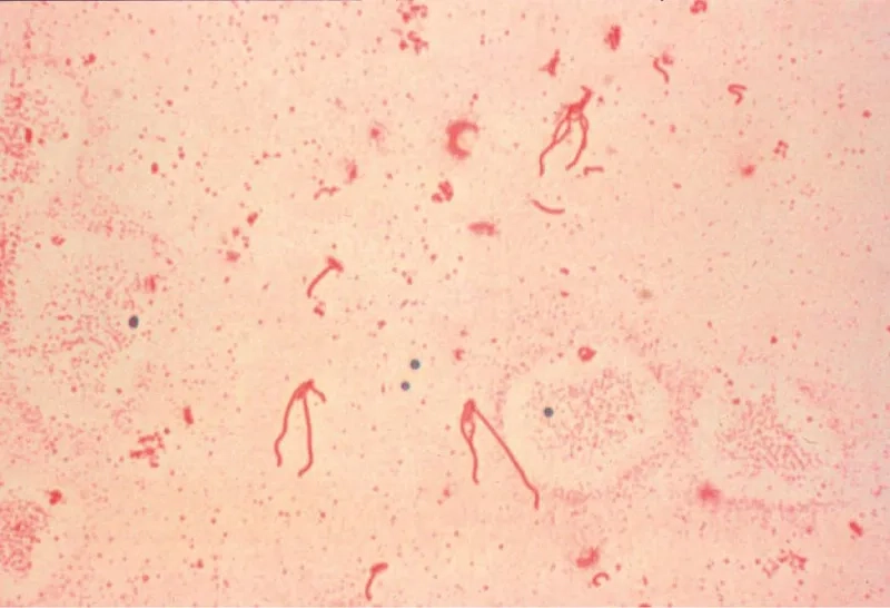 An ultrasound scan showing signs of pseudoappendicitis