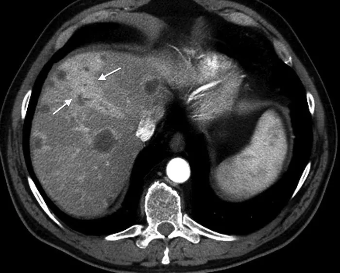 A pediatrician treating a case of yersiniosis in children