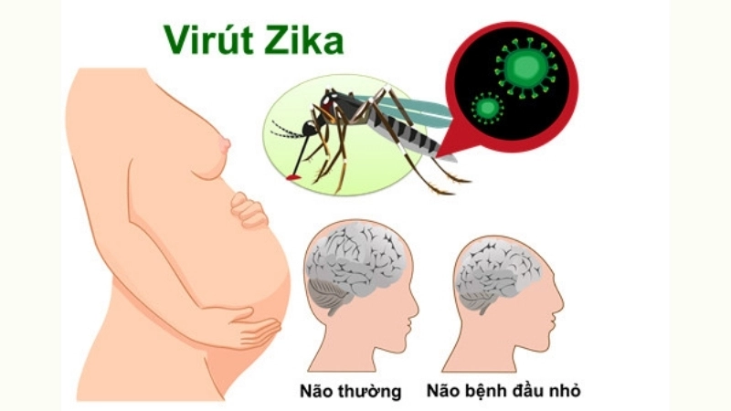 A compassionate photo of microcephaly Zika babies
